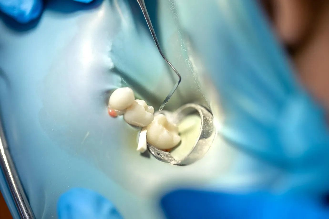 Dental Filling Treatment